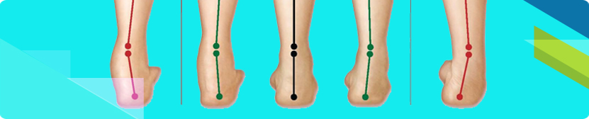 pronation-and-gait-over-pronation-injuries