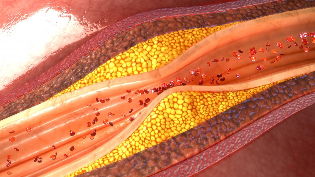 An Introduction To Atherosclerosis Hfe Blog